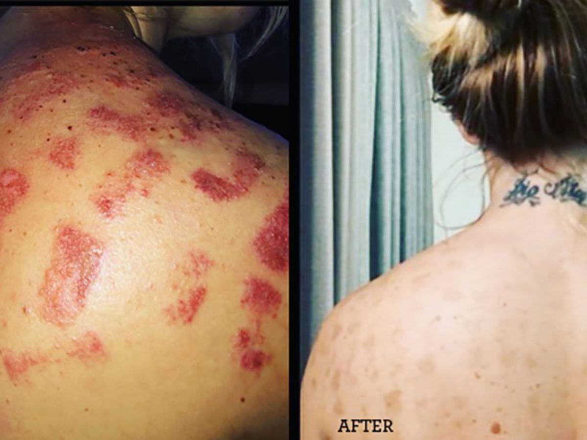 healing the skin with GERnétic